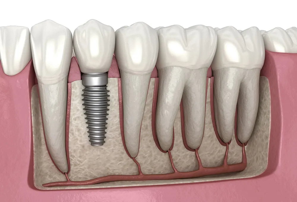 Dental-implant-illustration_gorseli